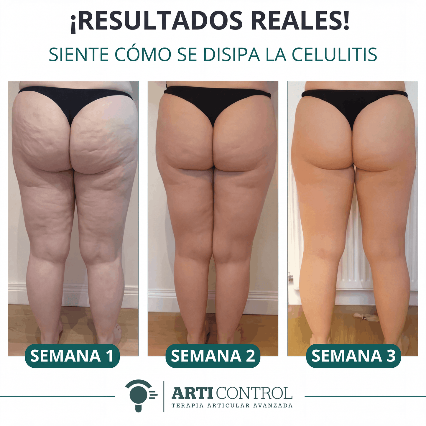 Celu Lift | Arti Control | Disuelve tu Celulitis Antes de Verano